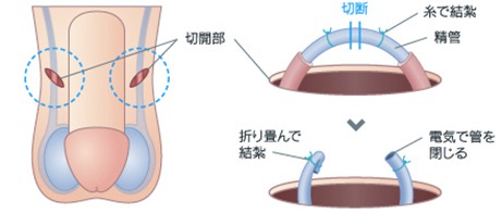 パイプカット手術画像