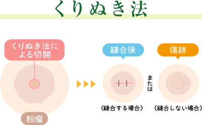 くりぬき法